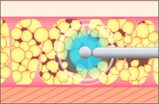 脂肪吸引のイメージ02